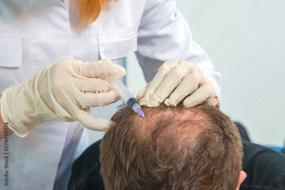 meso haartherapie 